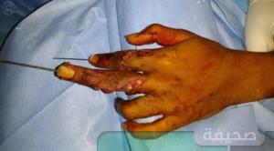 مستشفى بلجرشي ينجح في إنقاذ يد مواطن من البتر بعد تعرضها لإصابات بالغة