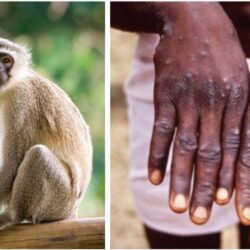 هل ستظهر متحورات لـ«جدري القرود»؟.. «الصحة العالمية» توضح