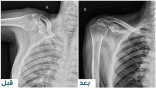 استبدال مِفصل الكتف يُعيد الحركة لمريض سبعينيّ في مستشفى المانع بالأحساء