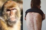 “الصحة العالمية” تحذّر من تفش أوسع لجدري القرود بسبب المهرجانات والحفلات الصيفية