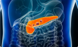 اختبار جديد لكشف “سرطان البنكرياس”