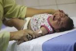وفاة 139طفلا وتشوه 641 آخرين منذ بدء انتشار فيروس”زيكا” في البرازيل