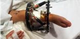 عملية جراحية دقيقة تنقذ ساق طفلة  ” 3 سنوات ” من البتر